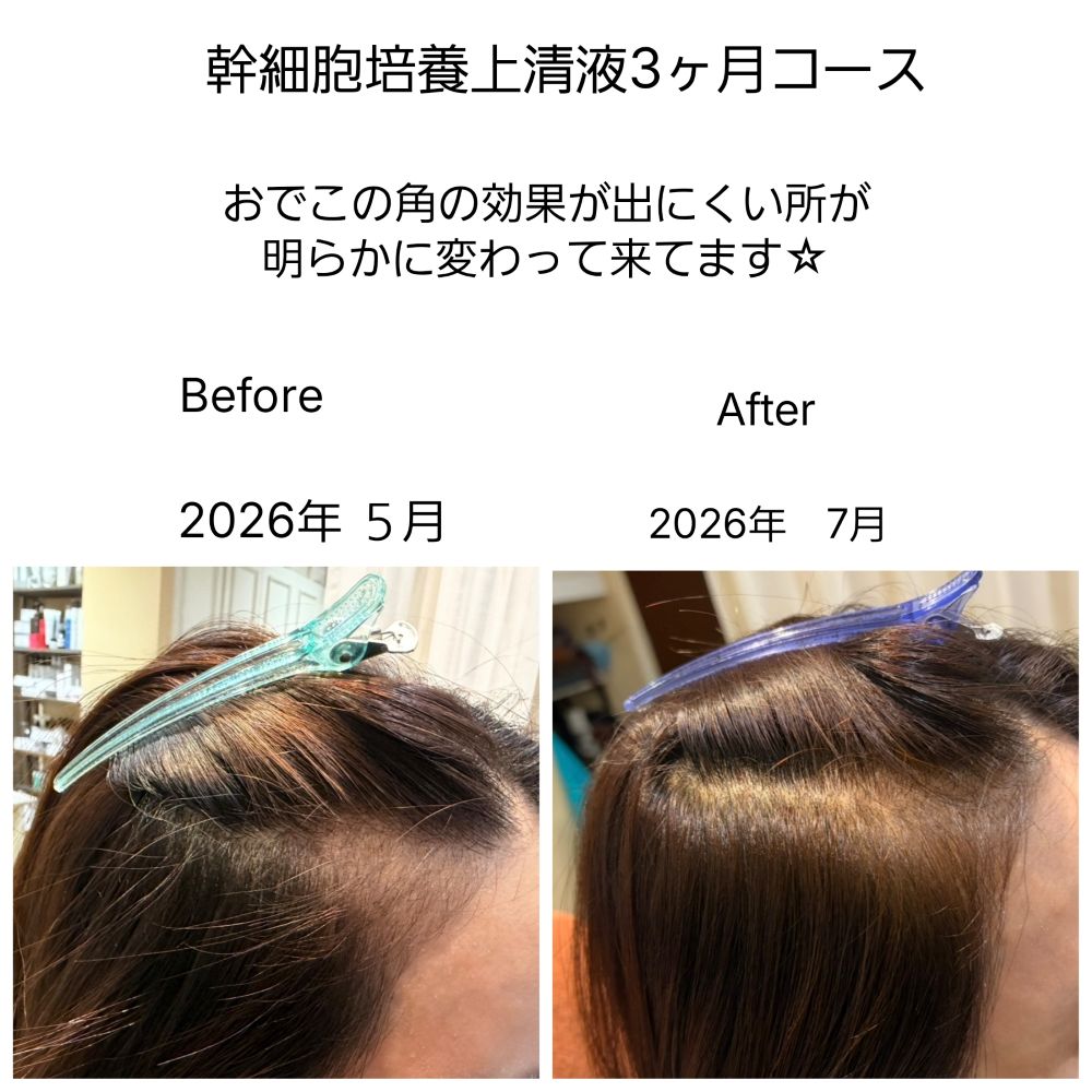 4、薄毛や細毛がお悩みの方へ 京都唯一の細毛改善メニューがあります(育毛 発毛について)