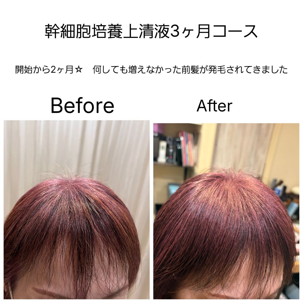 4、薄毛や細毛がお悩みの方へ 京都唯一の細毛改善メニューがあります(育毛 発毛について)